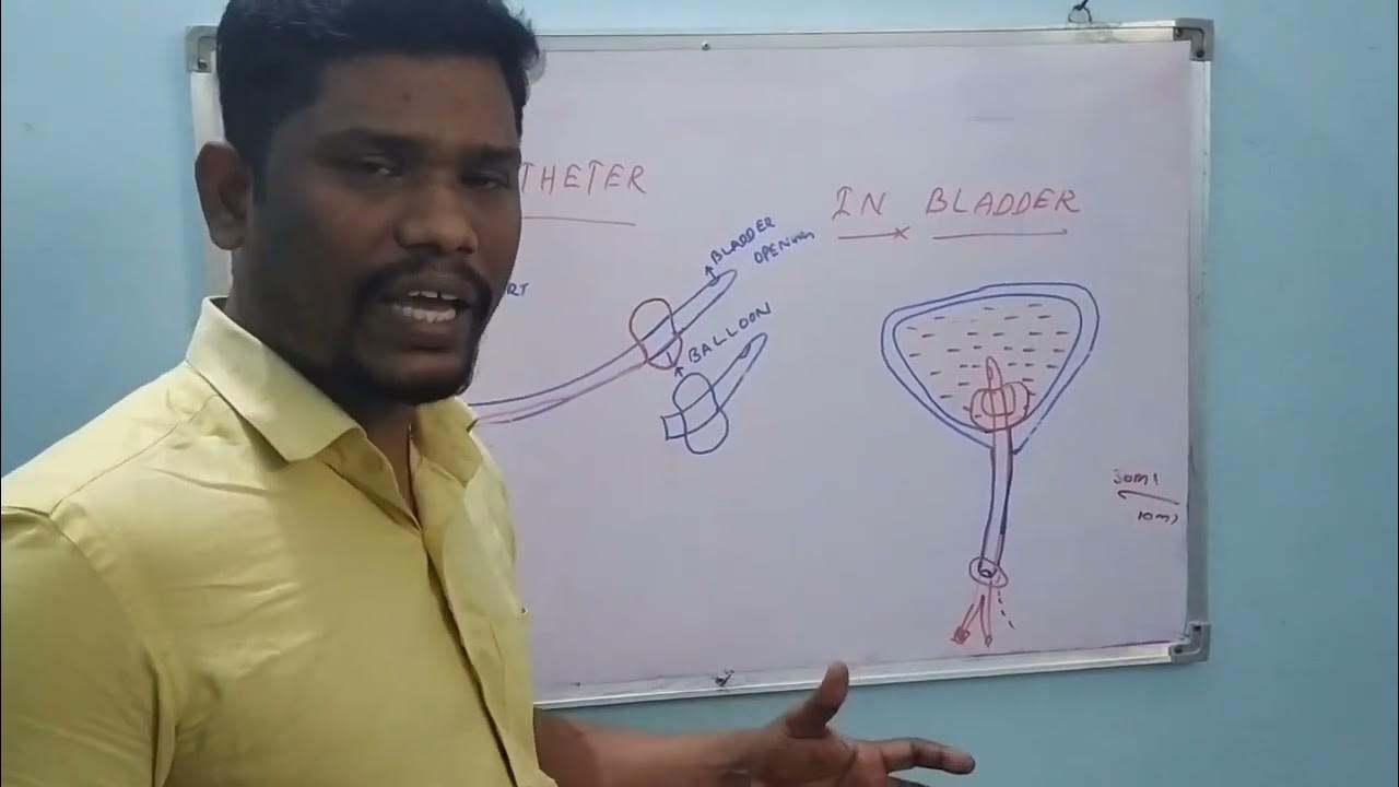 FOLEY'S CATHETER LEAKAGE PROBLEM CORRECTION METHOD.. URINE TUBE BLOCKAGE CORRECTION. urine tube