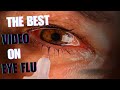 Eye Flu | Conjunctivitis | The Myth Buster | Do's and Don'ts