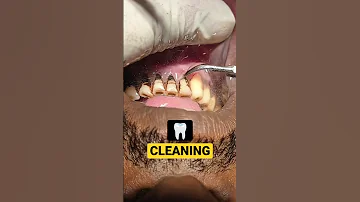 Pan - Smokers Teeth Cleaning #teethcleaning #dirtyteeth