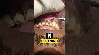 Pan - Smokers Teeth Cleaning #teethcleaning #dirtyteeth screenshot 5