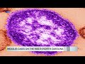 Measles cases surge in North and South Carolina