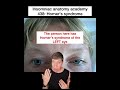 Insomniac anatomy academy 438: horners syndrome #science #stem #sciencefacts #anatomy #eyes