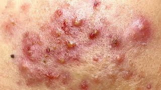 Make your Acne Treatment | Acne  spa 126 | Sac Dep Spa