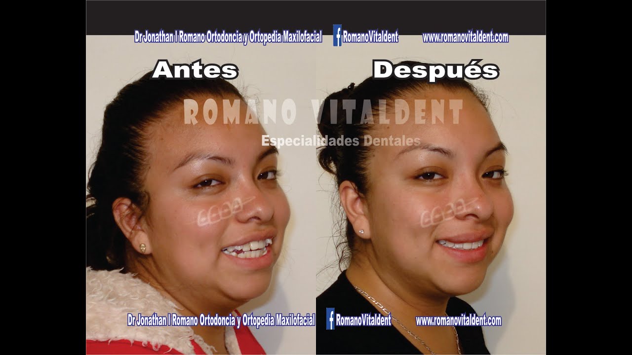 Tratamiento de ortodoncia completo .. todo el proceso a detalle con excelentes resultados