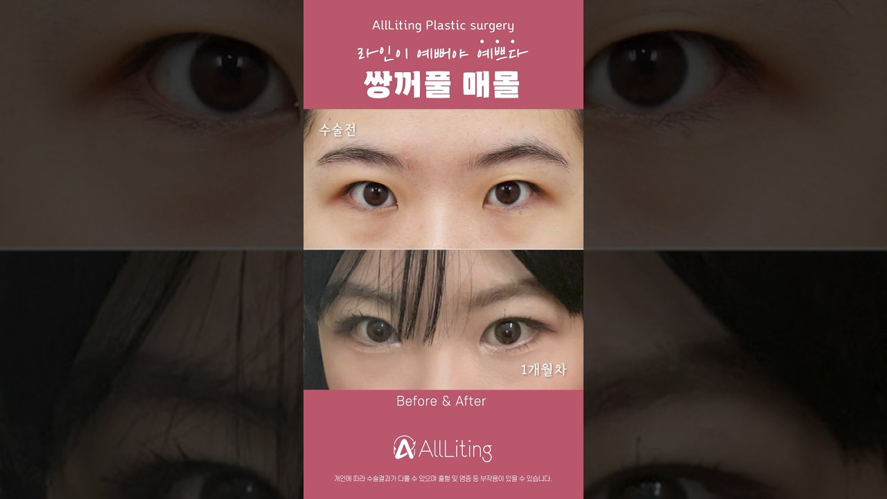 [奧莉婷整形外科診所] 如何快速變美？奧莉婷埋線雙眼皮就是答案 😉❤️ #江南埋線雙眼皮整形外科診所 #江南非切開雙眼皮整形外科診所