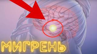 Мигрень - разобрали все варианты лечения - что реально работает?