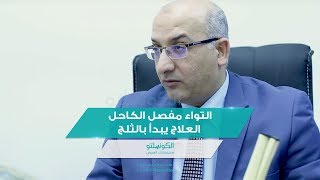 التواء مفصل الكاحل.. العلاج يبدأ بالثلج