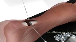 Surgical repair of a ruptured Achilles tendon
