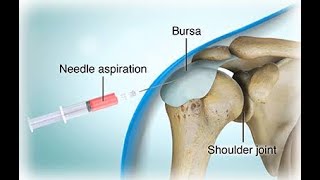 Joint aspiration, arthrocentesis; medical procedure, to remove fluid from a joint