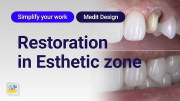 Simplify your work : Esthetic restoration