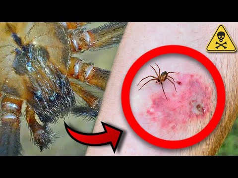Video: Dog Brown Recluse Bite Forgiftning - Brown Recluse Bit Forgiftning Behandlinger