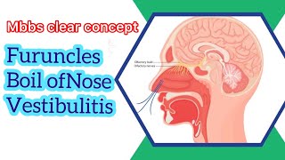 Furuncles | Boil of Nose | Vestibulitis | Disease of nasal vestibules