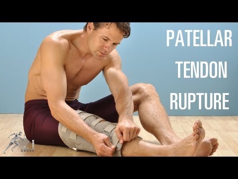 How can you tell if you tore your patellar tendon?
