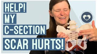 Why your C-section scar hurts and how to fix it! Pelvic PT explains