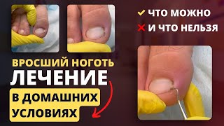Вросший ноготь: лечение в домашних условиях