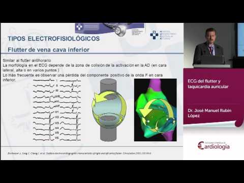 ECG del flutter y taquicardia auricular