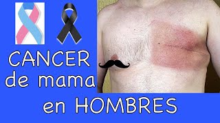 Cáncer de mama en Hombres