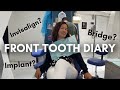 Come To Dentist Appointments With Me | Front Tooth Implant Or Bridge? Getting Invisalign!!!