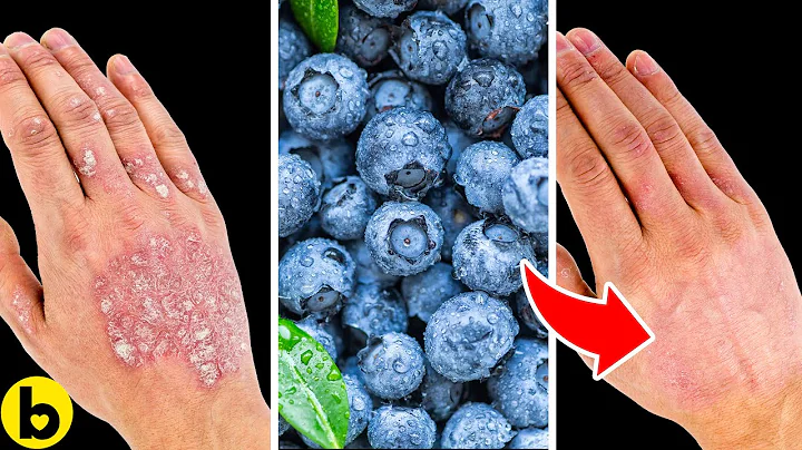 What You Should Eat If You Have Psoriatic Arthritis