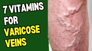 7 Vitamins For Varicose Veins