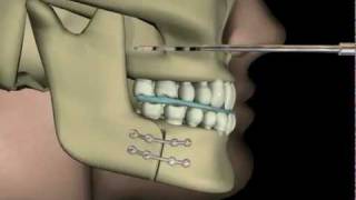 Çift Çene Ameliyatı(Upper and Lower Jaw Surgery)