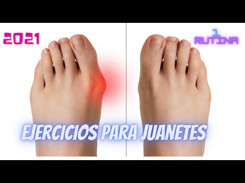 Video: Maneras sencillas de quitar astillas de los pies: 12 pasos