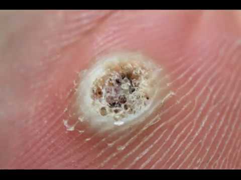 Death of a Wart (timelapse) - YouTube the nitrogen cycle diagram 