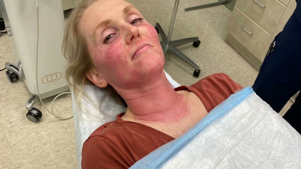 Morpheus 8, 2nd procedure.  OUCH!!!