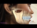 TMJ Occlusal Splint TMJ Occlusal Splint
