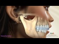 Tmj occlusal splint