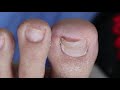 Ep_2745 Foot nails skin removal 👣 มีก้อนแข็ง..อยู่ข้างเล็บ 😷 (This clip is from Thailand)