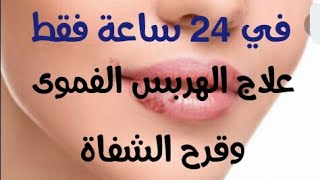 علاج الهربس الفموى وقرح الشفاة في 24 ساعة 