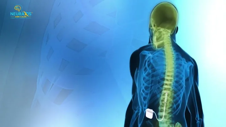 New hope for spinal cord injury patients to gain the motor control with Epidural stimulation