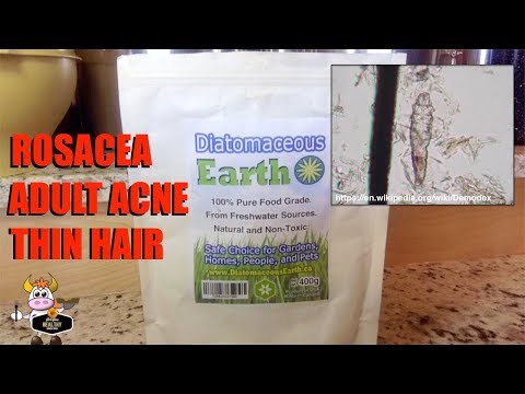 Adult Acne: Put an End to Adult Acne and Rosacea with Diatomaceous Earth Food-Grade (DE benefits)