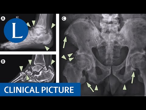 Clinical Picture | Enthesophathy in X-linked hypophosphataemia