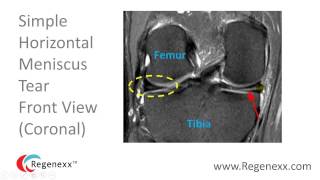 How to Read a Knee MRI for Meniscus Tears