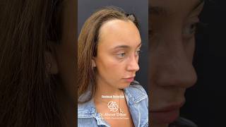 Forehead Reduction Dr. Ahmet Dilber