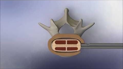 VTI: InterFuse L Insertion Technique