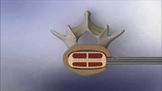 VTI: InterFuse L Insertion Technique