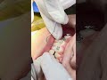 How to fix brace #dentist #teeth