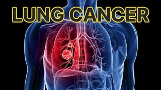 Lung Cancer (updated 2023)  CRASH! Medical Review Series