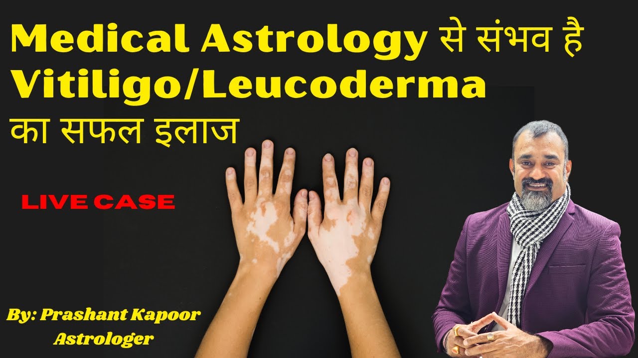 Medical Astrology से संभव है Vitiligo/Leucoderma का सफल इलाज Prashant