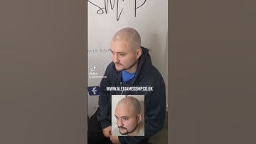 Scalp Micropigmentation - Get your hairline back!