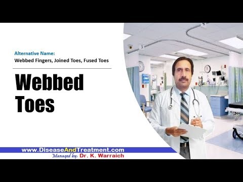webbed-toes-(webbed-fingers)-:-causes,-diagnosis,-symptoms,-treatment,-prognosis