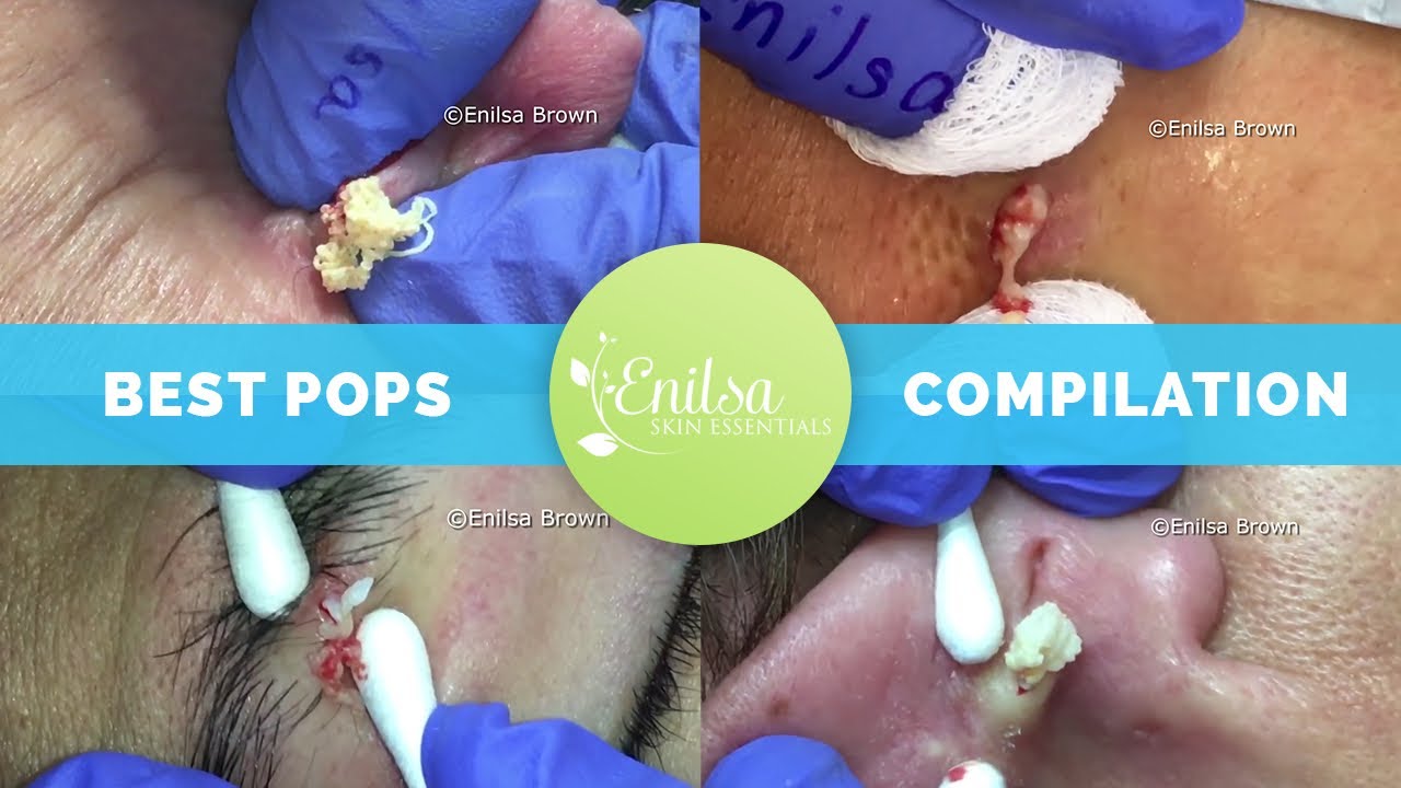 A compilation of cysts