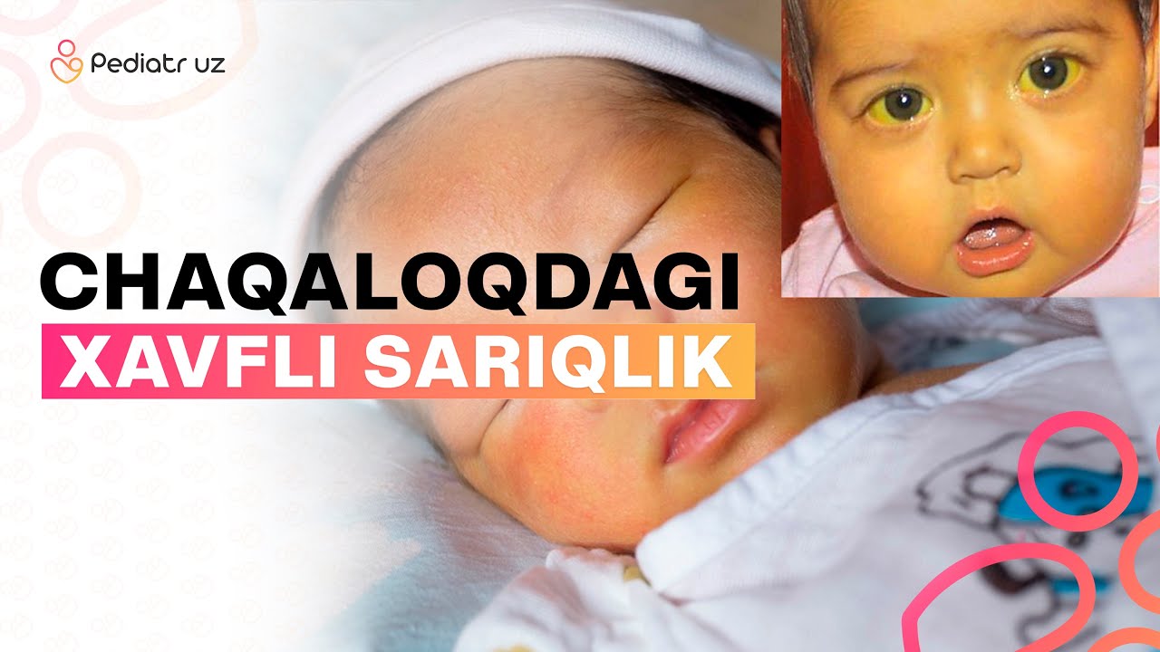 Чақалоқларда сариклик: сабаблари ва хавфли асоратлари