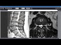 Severe Foot Drop: the Clinical & MRI Findings of a Real Client with a Surprise Finding