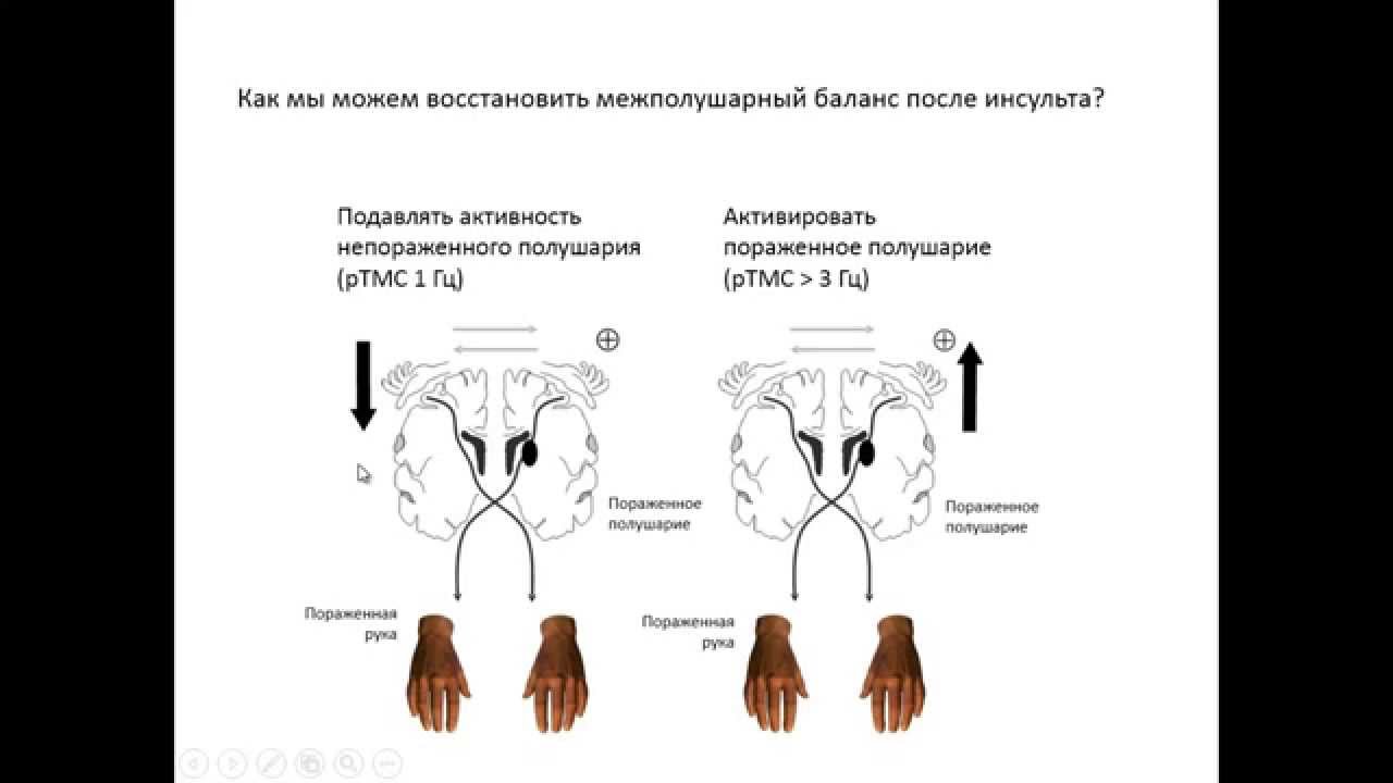 ⁣ТМС в реабилитации после инсульта