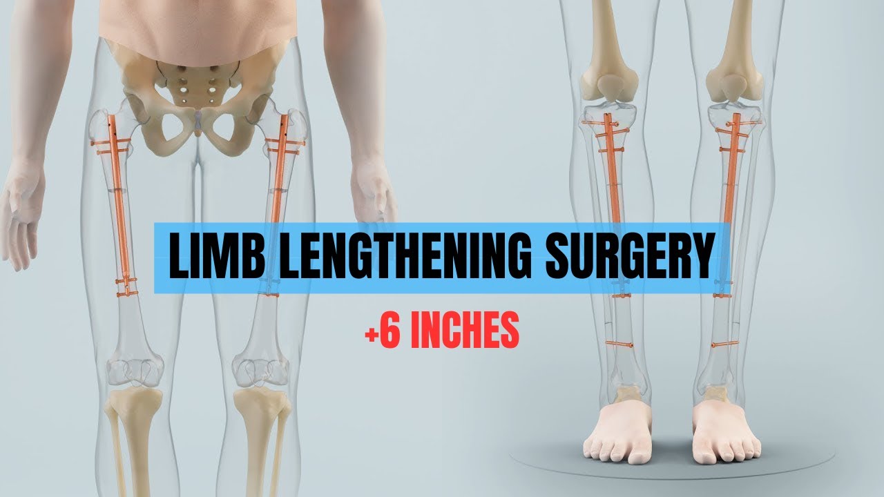 Get taller using Grow Taller Surgery | 6-10 cm of height with Limb