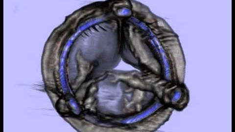 3D Aortic Valve Stent Graft